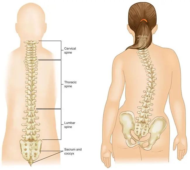 escoliosis toracica - Cómo afecta la escoliosis a la caja torácica