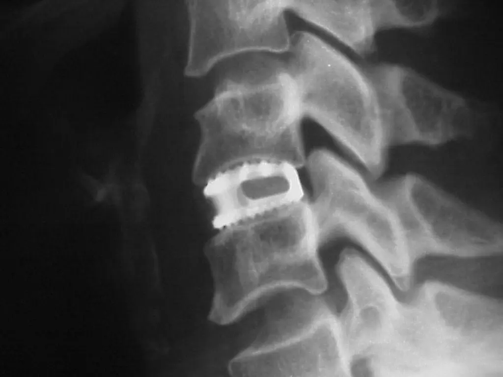Artrodesis de Columna: Cómo Recuperarse y Caminar Después de la Cirugía - Cómo agacharse después de una artrodesis lumbar artrodesis de columna - Cómo agacharse después de una artrodesis lumbar