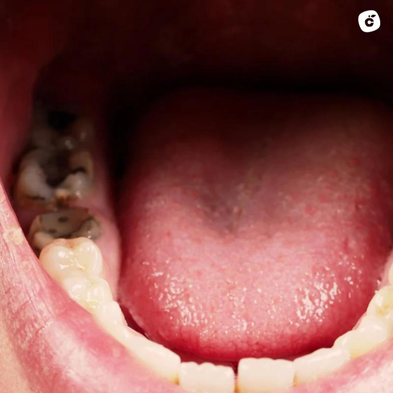 Dolor de muelas por infección: Causas, síntomas y tratamientos - Cómo aliviar el dolor de infección de muela infeccion dolor de muela - Cómo aliviar el dolor de infección de muela