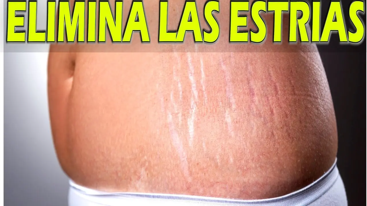 Cómo eliminar las estrías blancas: guía completa - Cómo borrar estrías blancas como sacar las estrias - Cómo borrar estrías blancas
