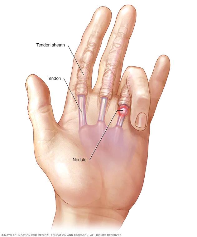 Dedo en gatillo: Causas, síntomas y tratamiento - Cómo curar el dedo pulgar en gatillo dedo en gatillo pulgar - Cómo curar el dedo pulgar en gatillo