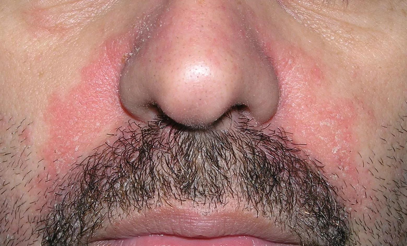 Cómo Tratar la Caspa Facial: Guía Completa para Eliminar la Piel Seca y Flaky - Cómo curar la caspa facial caspa en la cara tratamiento - Cómo curar la caspa facial