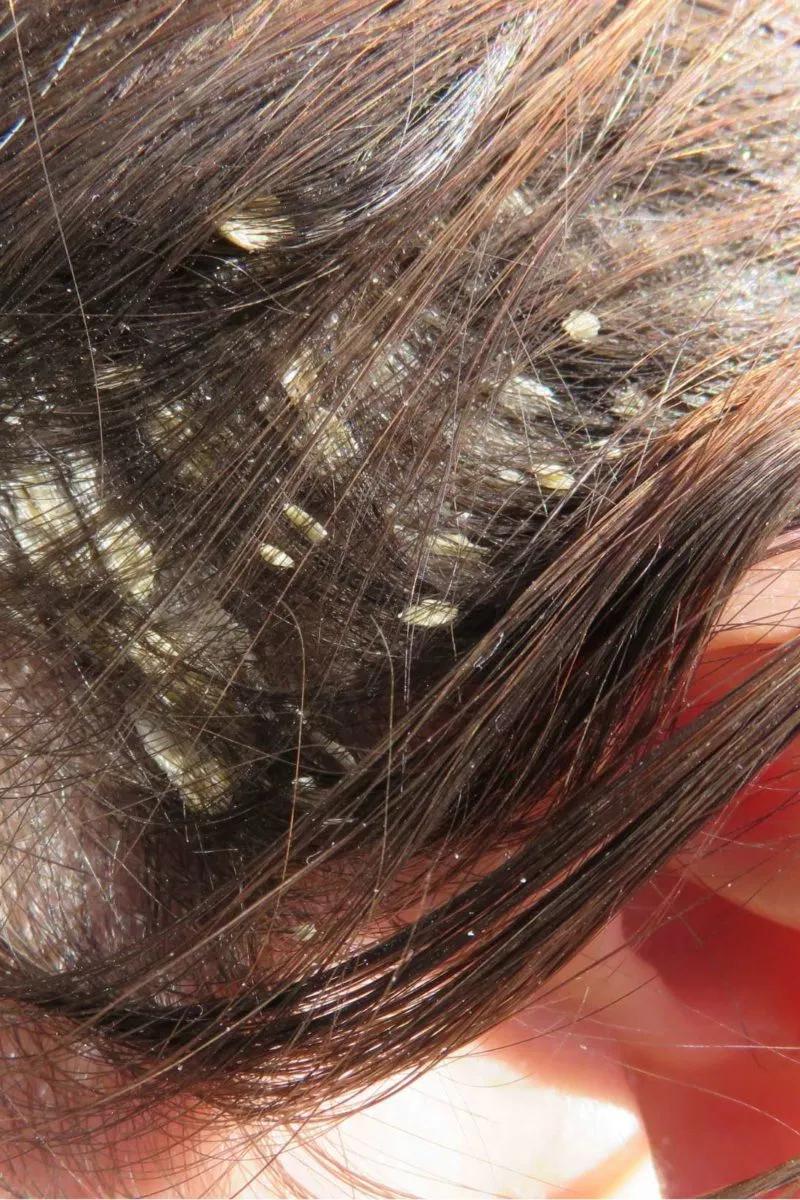 Dermatitis Atópica en el Cuero Cabelludo: Síntomas, Causas y Tratamiento - Cómo curar la dermatitis atópica en el cuero cabelludo dermatitis atopica cuero cabelludo - Cómo curar la dermatitis atópica en el cuero cabelludo