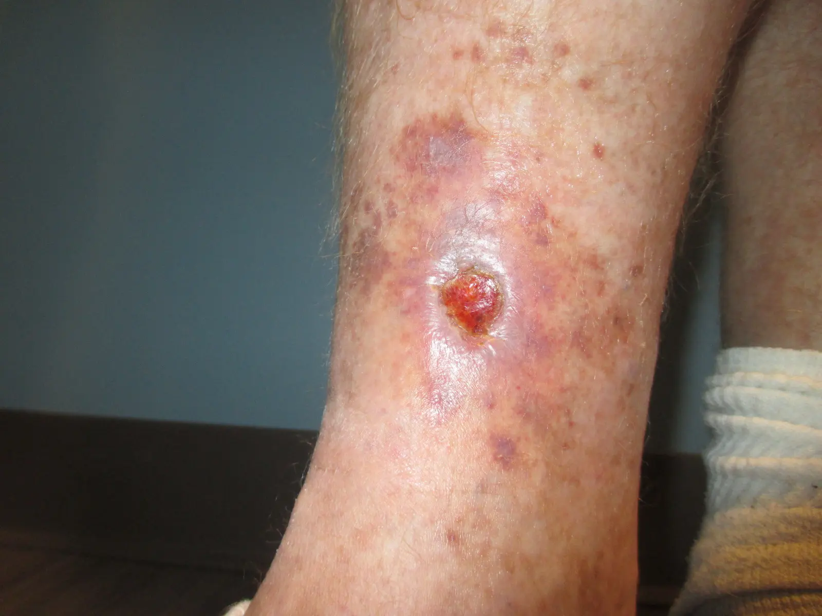 Dermatitis por estasis: causas, síntomas, tratamiento y prevención - Cómo curar la estasis estasis venosa - Cómo curar la estasis