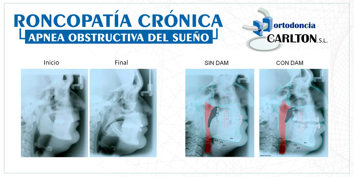 Roncopatía: Más que un simple ronquido - Cómo curar la roncopatía roncopatía - Cómo curar la roncopatía