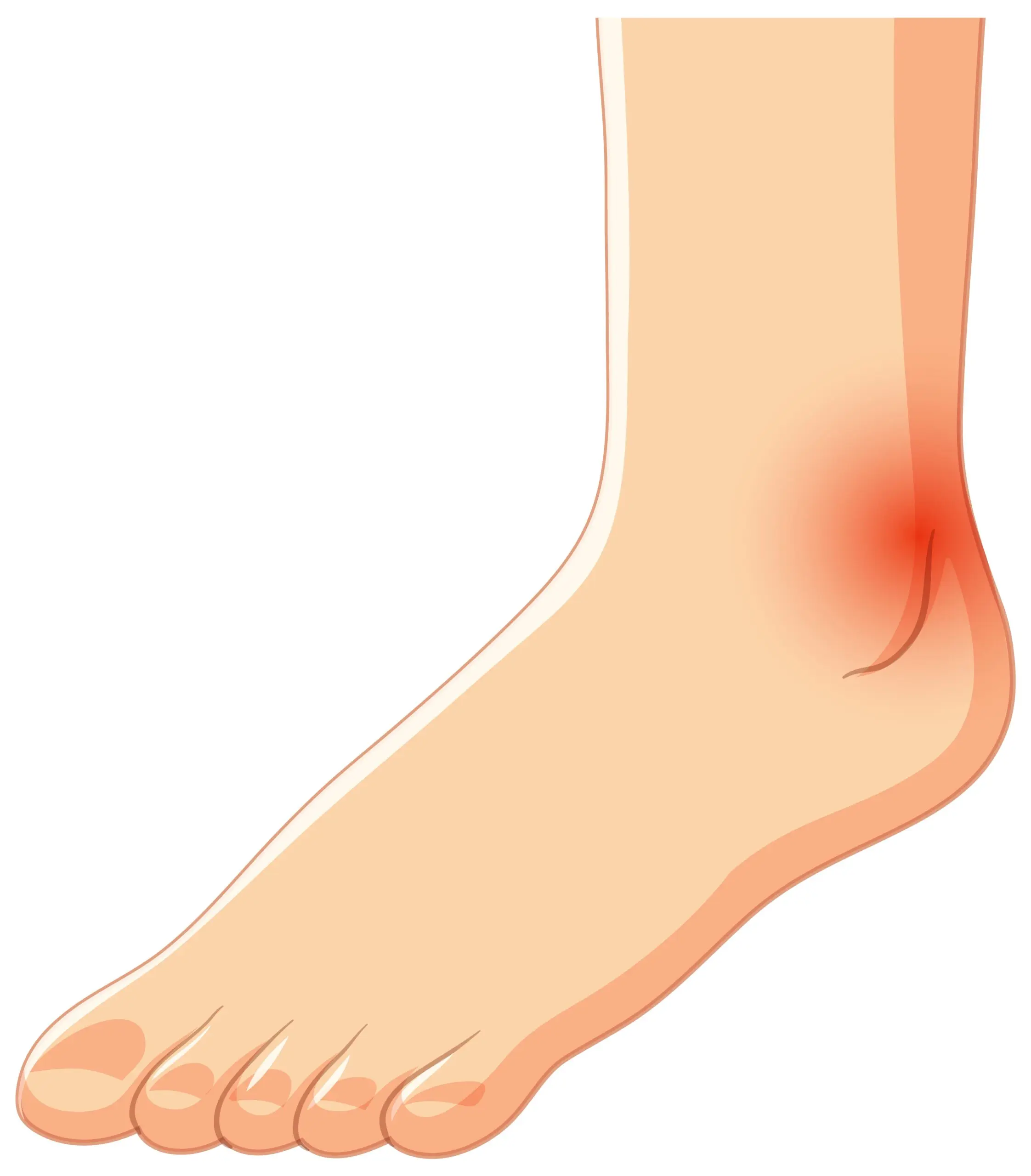 dolor en el tendon de aquiles - Cómo curar la tendinitis del tendón de Aquiles