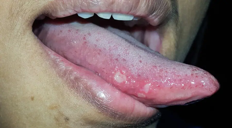 Lastimaduras en la Lengua: Causas, Remedios y Cuidados - Cómo curar las heridas que salen en la lengua lastimaduras en la lengua - Cómo curar las heridas que salen en la lengua