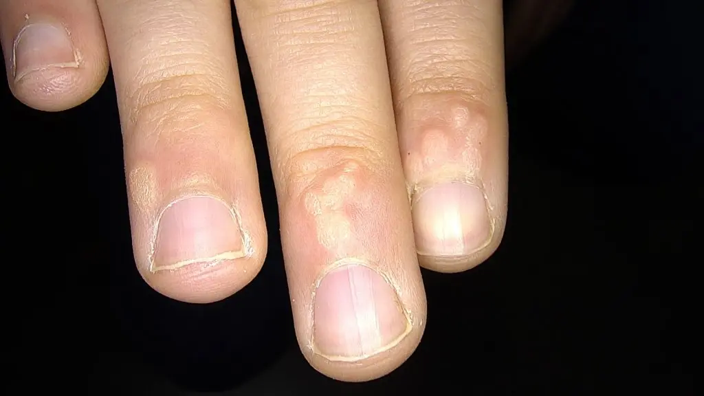 Verrugas Periungueales: Causas, Tratamiento y Cuidados - Cómo curar las verrugas en las uñas de los dedos verrugas periungueales - Cómo curar las verrugas en las uñas de los dedos