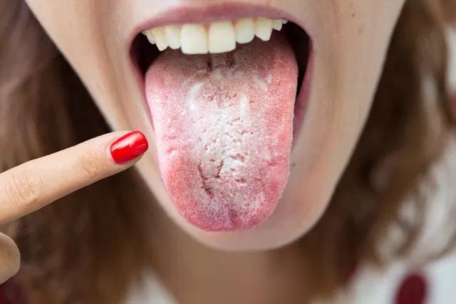 Cómo desinflamar la lengua y la garganta: Causas, remedios caseros y cuándo consultar al médico - Cómo desinflamar la lengua y la garganta dolor de lengua y garganta - Cómo desinflamar la lengua y la garganta