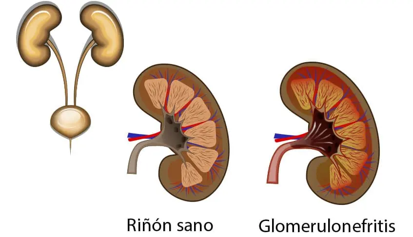 Glomerulonefritis: Diagnóstico, Tratamiento y Cuidados - Cómo desinflamar los glomérulos glomerulonefritis tratamiento - Cómo desinflamar los glomérulos