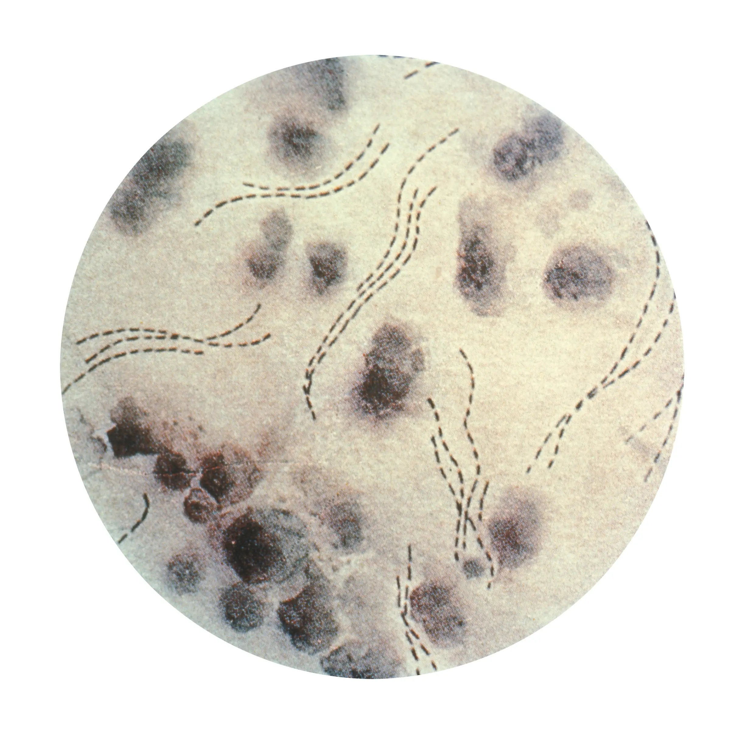 Diagnóstico del Chancro Blando: Haemophilus ducreyi - Cómo diagnosticar Haemophilus ducreyi haemophilus ducreyi - Cómo diagnosticar Haemophilus ducreyi