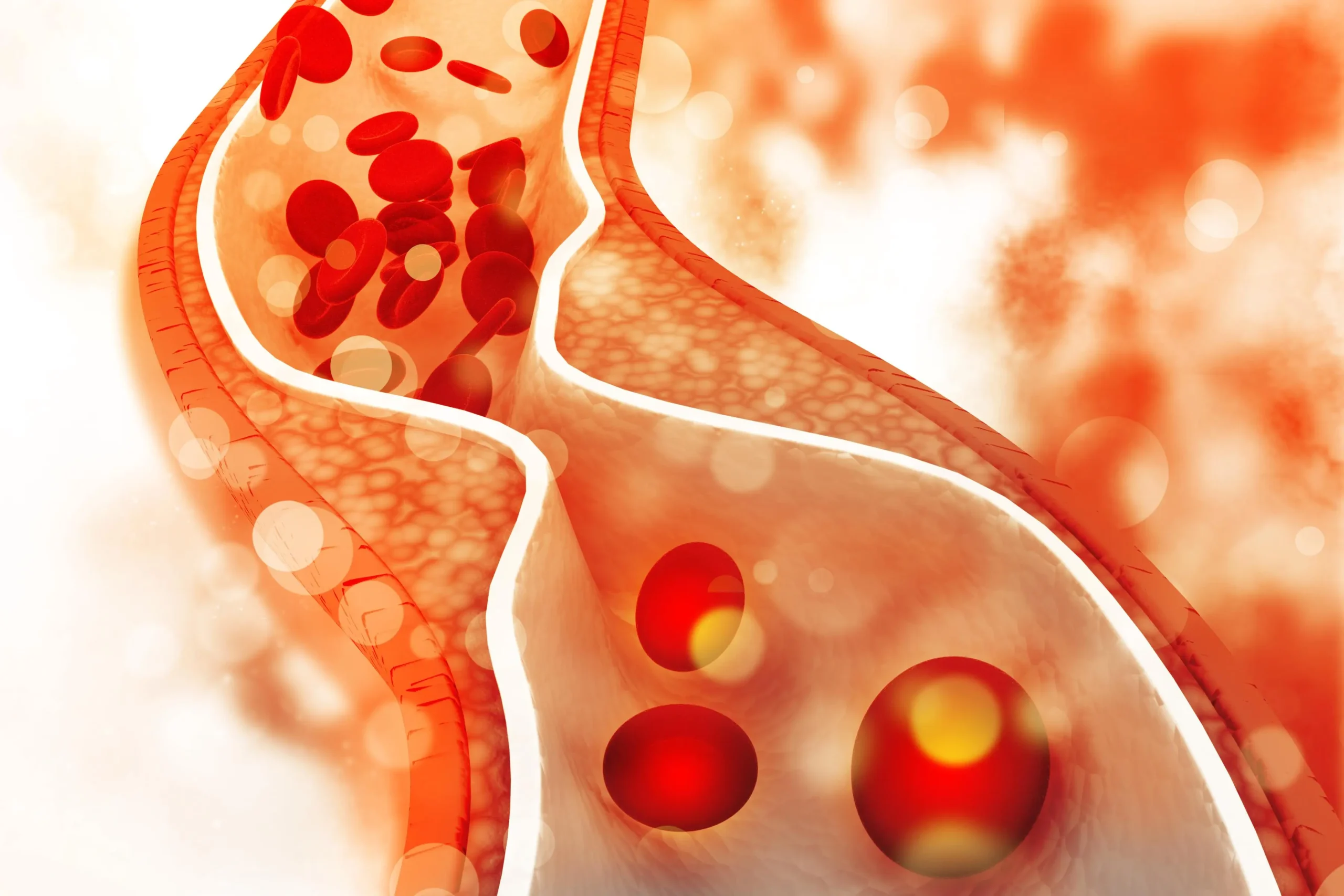 Estenosis Arterial: Causas, Síntomas, Diagnóstico y Tratamiento - Cómo disminuir la estenosis carotídea estenosis arterial - Cómo disminuir la estenosis carotídea