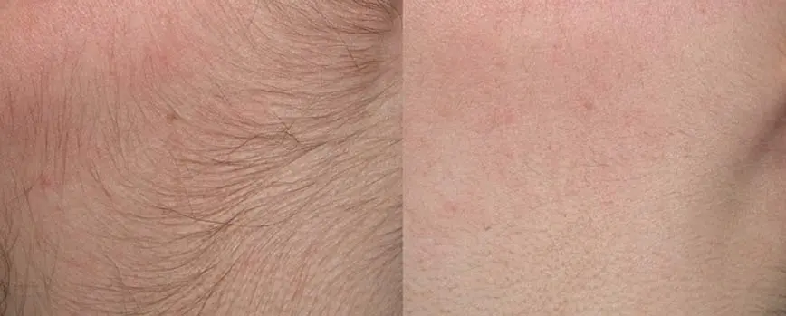 Cómo Eliminar el Vello Facial Femenino: Guía Completa con Métodos y Consejos - Cómo eliminar el vello femenino de la cara vello facial mujer - Cómo eliminar el vello femenino de la cara