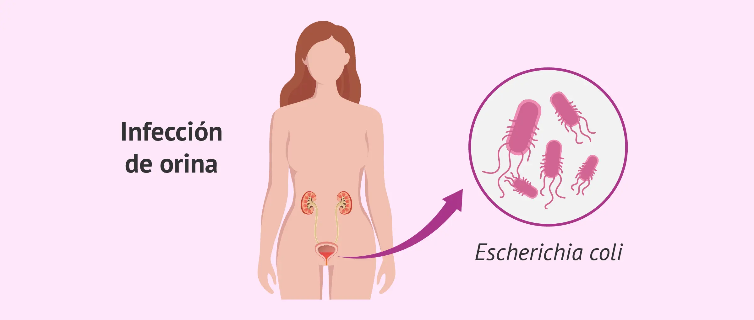 E. coli e Infección Urinaria: Causas, Síntomas y Tratamiento - Cómo eliminar la bacteria E. coli de las vías urinarias e coli infeccion urinaria - Cómo eliminar la bacteria E. coli de las vías urinarias