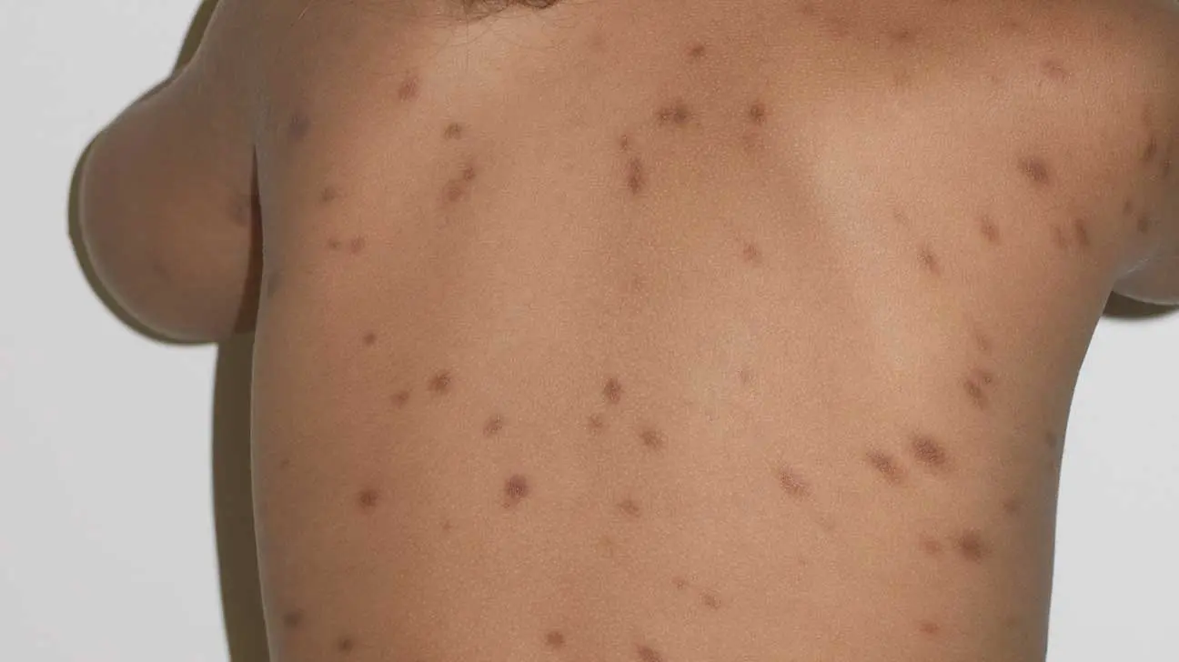 Urticaria Pigmentosa: Una Guía Completa para Padres e Hijos - Cómo eliminar las manchas de urticaria pigmentosa urticaria pigmentosa - Cómo eliminar las manchas de urticaria pigmentosa