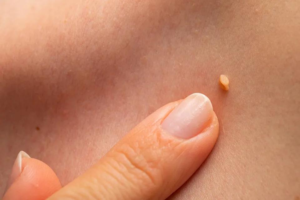 Síntomas del VPH: Lo que debes saber - Cómo empiezan los síntomas de VPH sintomas de vph - Cómo empiezan los síntomas de VPH
