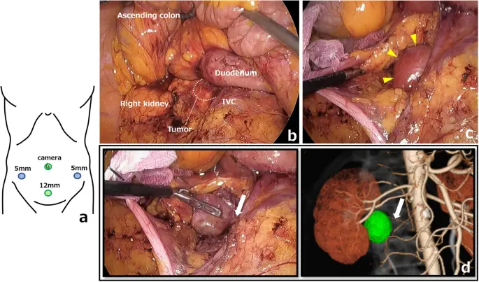 Tumor Retroperitoneal: Un Reto para la Salud - Cómo es el dolor retroperitoneal tumor retroperitoneal - Cómo es el dolor retroperitoneal