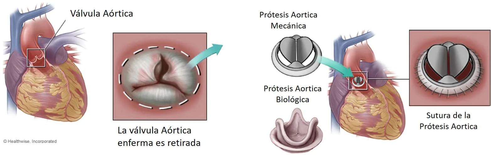 Cambio de Válvula Aórtica: Un Procedimiento para Mejorar la Salud Cardíaca - Cómo es la operación de cambio de válvula aórtica cambio de valvula aortica - Cómo es la operación de cambio de válvula aórtica