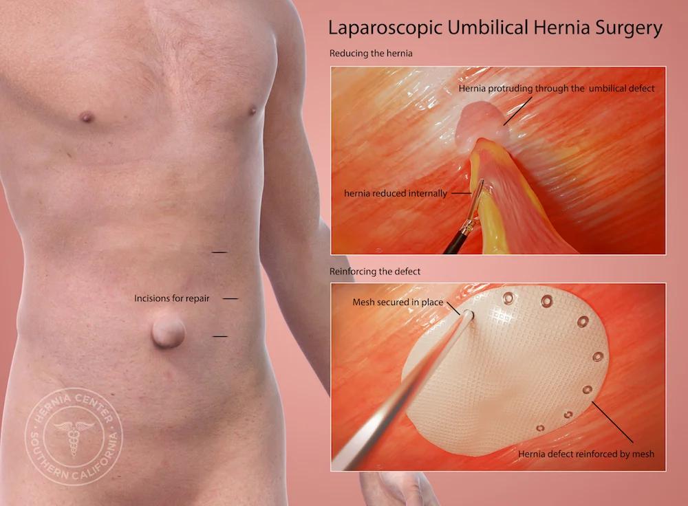 Operación de Hernia Umbilical en Adultos: Todo lo que Necesitas Saber - Cómo es la operación de hernia umbilical en adultos operacion de hernia umbilical - Cómo es la operación de hernia umbilical en adultos