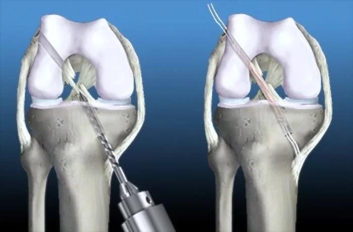 Operación de Ligamento Cruzado: Todo lo que necesitas saber - Cómo es la operación de un ligamento cruzado operacion de ligamentos cruzados - Cómo es la operación de un ligamento cruzado