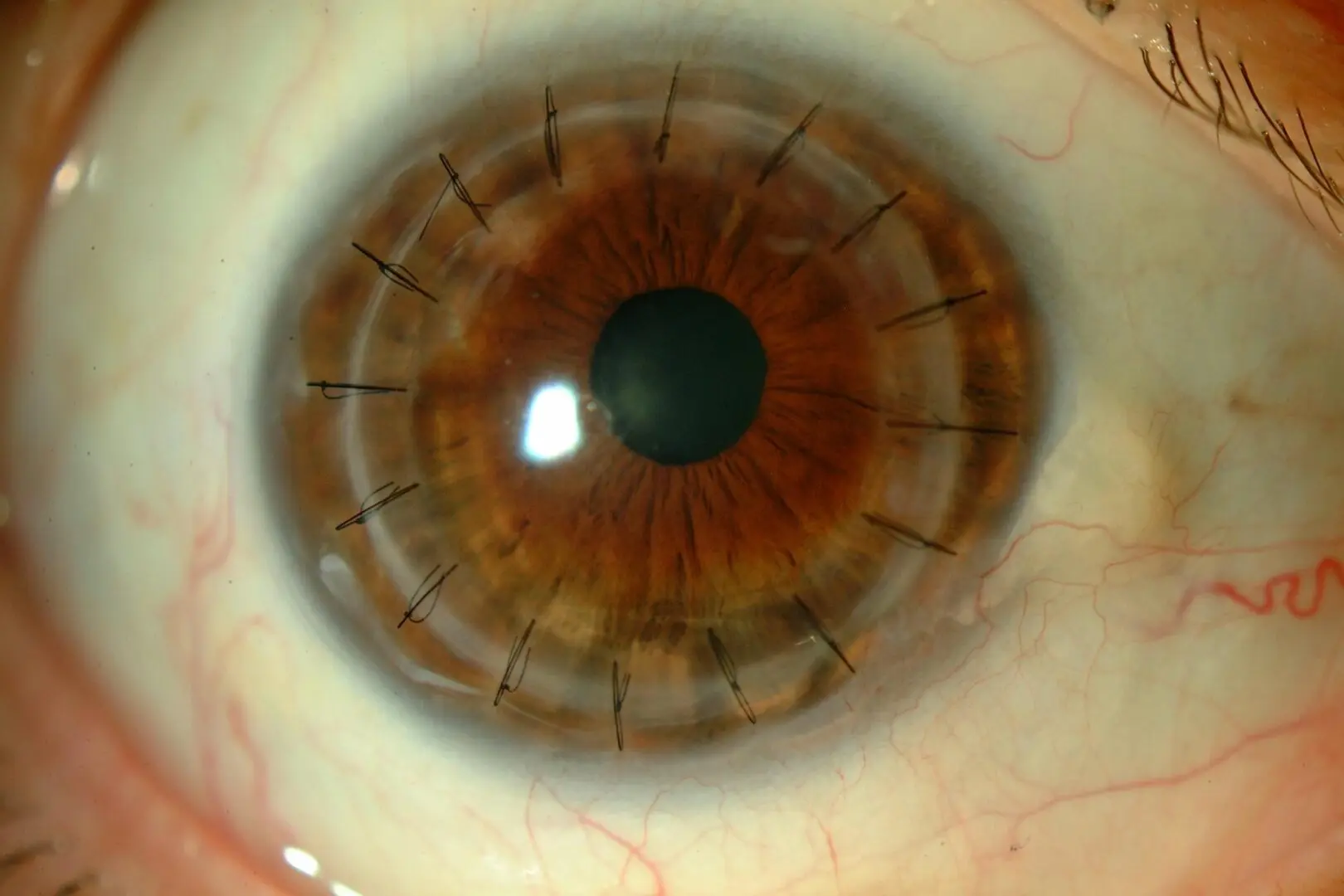 Trasplante de Córnea: Recuperando la Visión - Cómo es la visión después de un trasplante de córnea transplante de cornea - Cómo es la visión después de un trasplante de córnea