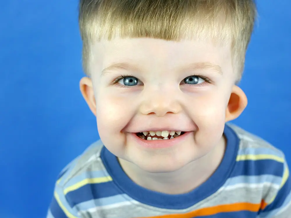 Síndrome de Williams: Una Afección Genética que Afecta al Cuerpo - Cómo es un bebé con síndrome de Williams williams syndrome - Cómo es un bebé con síndrome de Williams