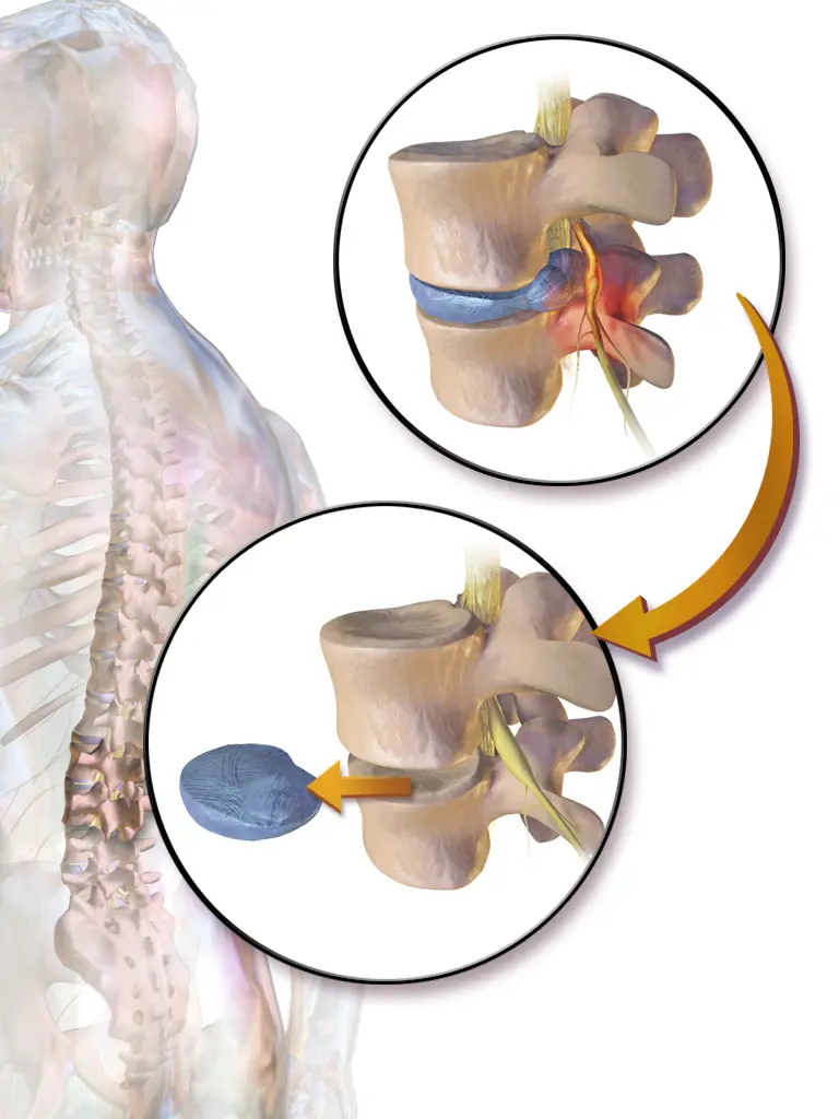 Discectomía Lumbar: Una Guía Completa para Comprender la Cirugía - Cómo es una cirugía de disco lumbar discectomía lumbar - Cómo es una cirugía de disco lumbar