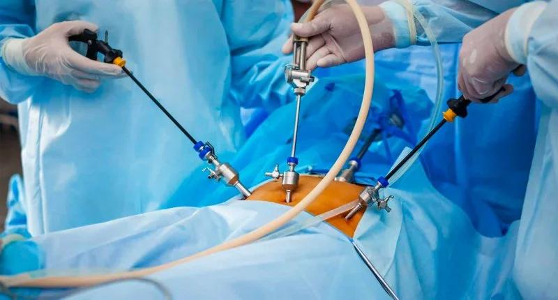 Laparoscopia de Apéndice: Una Intervención Mínimamente Invasiva - Cómo es una laparoscopia de apéndice laparoscopia apendicitis - Cómo es una laparoscopia de apéndice