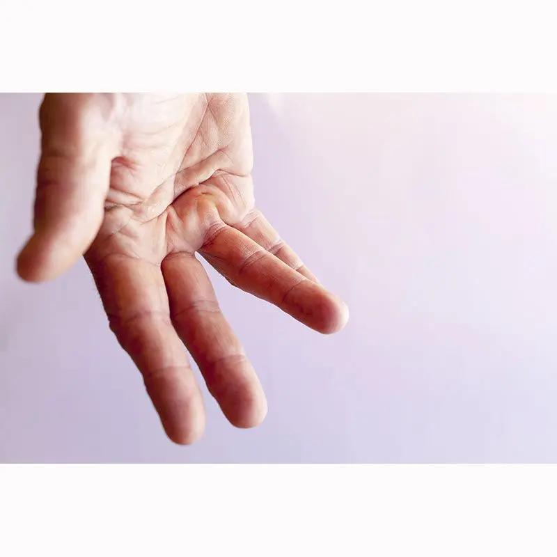 Contractura de Dupuytren: Causas, Síntomas, Tratamiento y Prevención - Cómo frenar Dupuytren contractura palmar de dupuytren - Cómo frenar Dupuytren