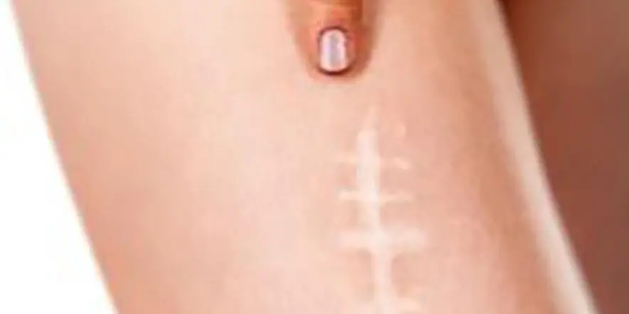 Cómo Eliminar Cicatrices Rápidamente: Guía Completa para una Piel Perfecta - Cómo hacer que no quede cicatriz como quitar cicatrices rapido - Cómo hacer que no quede cicatriz