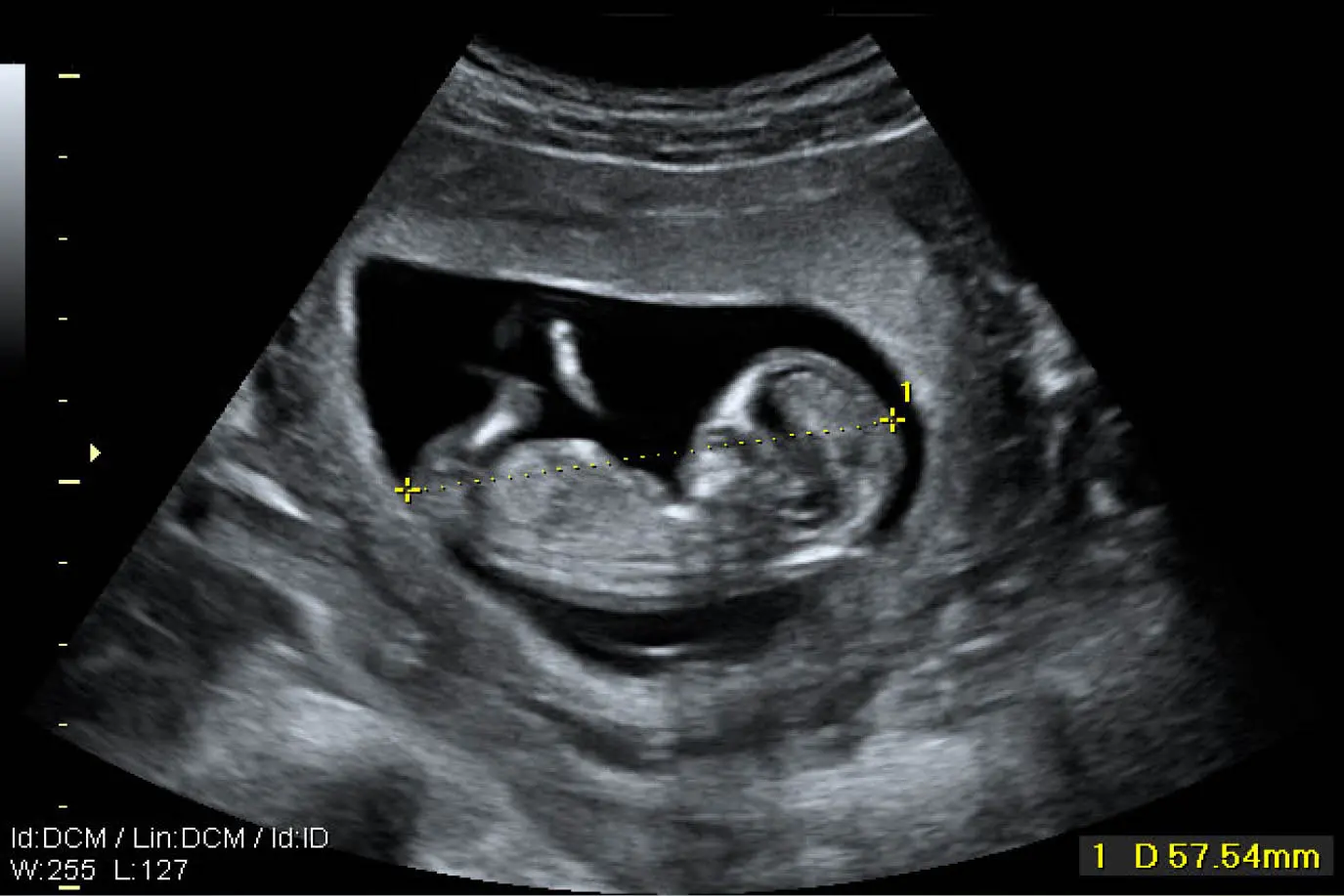 Ecografía Obstétrica: Una guía completa para la futura mamá - Cómo hacer una ecografía obstétrica eco obstetrico - Cómo hacer una ecografía obstétrica