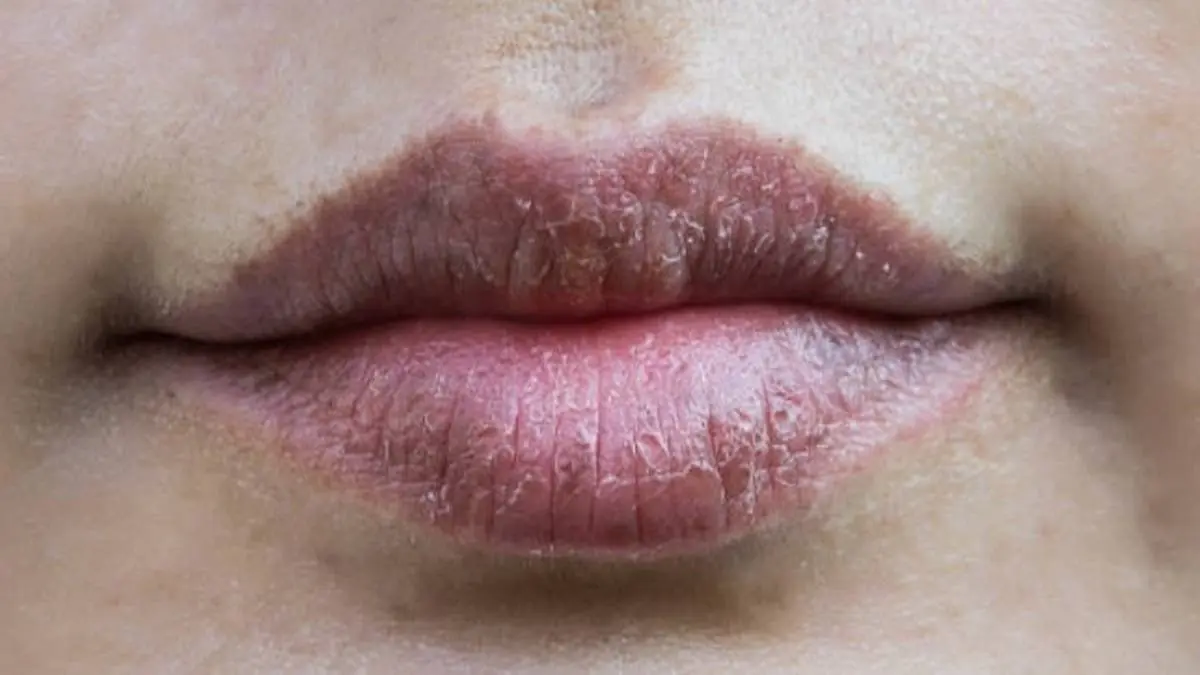 Cómo hidratar los labios secos con remedios caseros: guía completa - Cómo hidratar los labios secos con remedios caseros labios paspados remedios caseros - Cómo hidratar los labios secos con remedios caseros