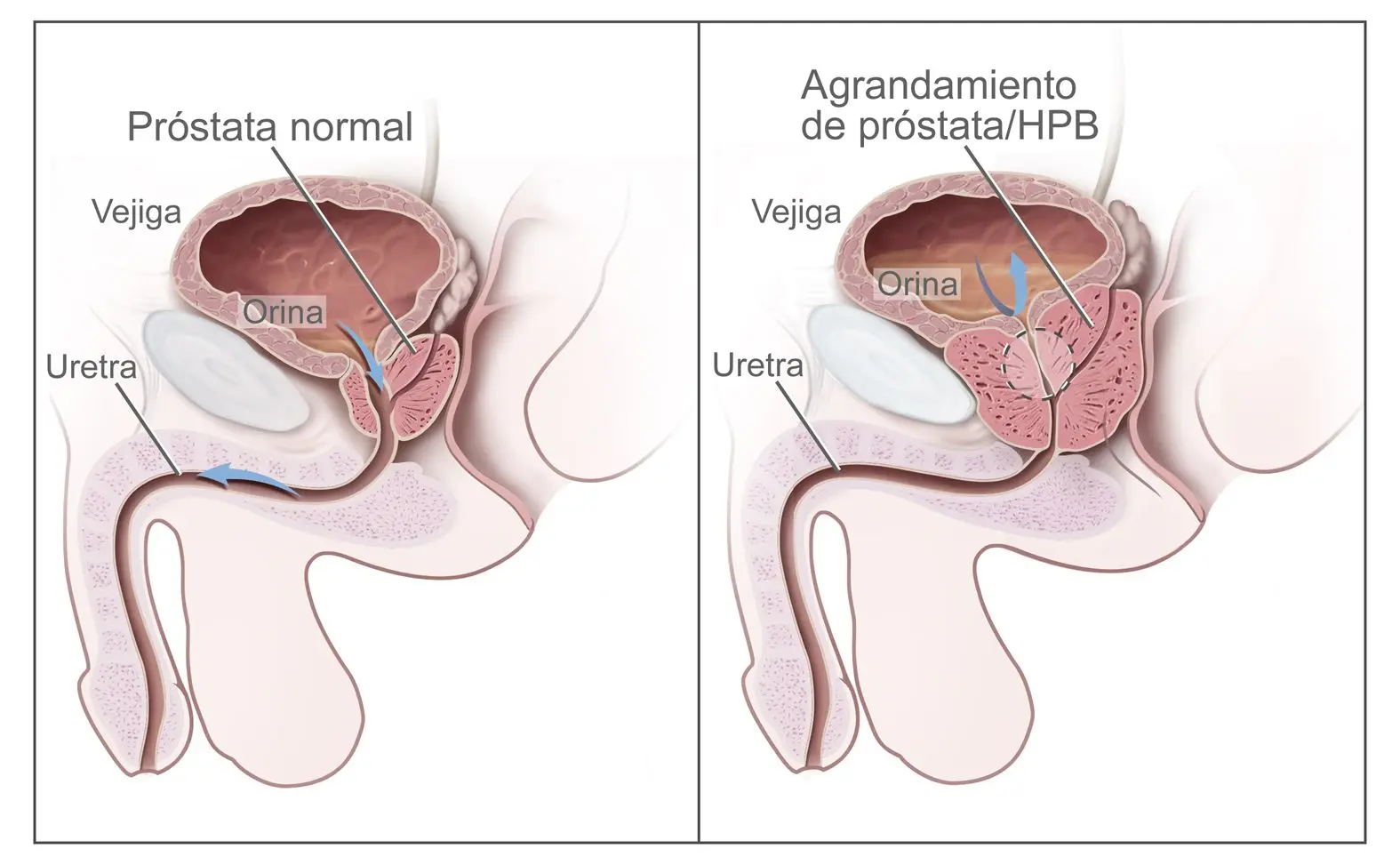 Tipos de Examen de Próstata: Una Guía Completa - Cómo le revisan la próstata a los hombres tipos de examen de prostata - Cómo le revisan la próstata a los hombres
