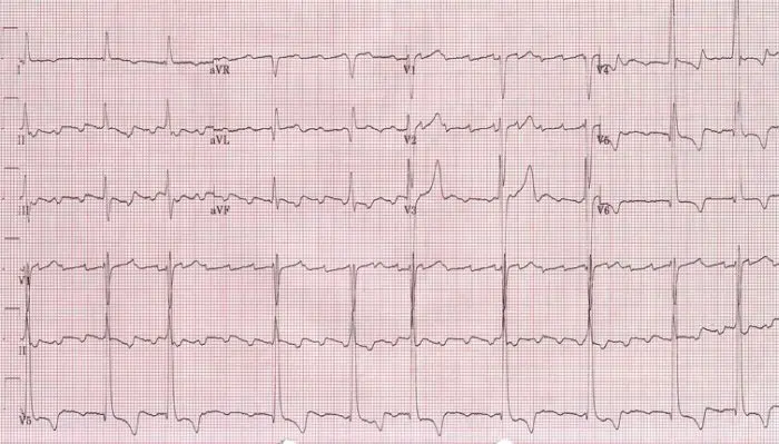 Aleteo Auricular en ECG: Interpretación y Significado - Cómo leer el aleteo auricular en un ECG aleteo auricular ecg - Cómo leer el aleteo auricular en un ECG