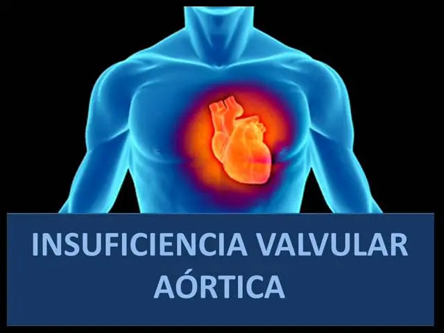 Insuficiencia Aórtica Leve: ¿Cuándo Operar y Cómo Mejorarla? - Cómo mejorar la insuficiencia aórtica insuficiencia aortica leve - Cómo mejorar la insuficiencia aórtica
