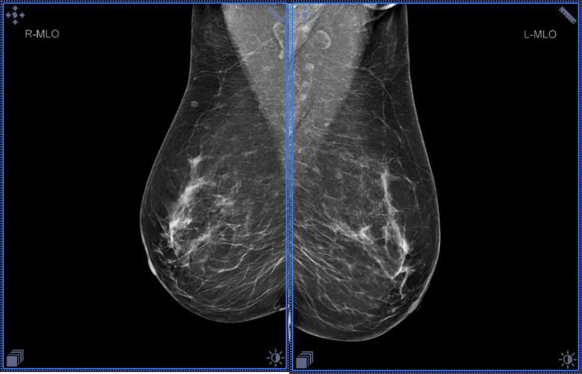 Mamás densas: ¿Dolor y riesgo de cáncer? - Cómo mejorar las mamas densas mamas densas duelen - Cómo mejorar las mamas densas