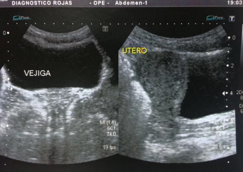Ecografía Abdominal: Preparación, Procedimiento y Resultados - Cómo prepararse para una ecografía abdominal ecografia abdominal preparacion - Cómo prepararse para una ecografía abdominal