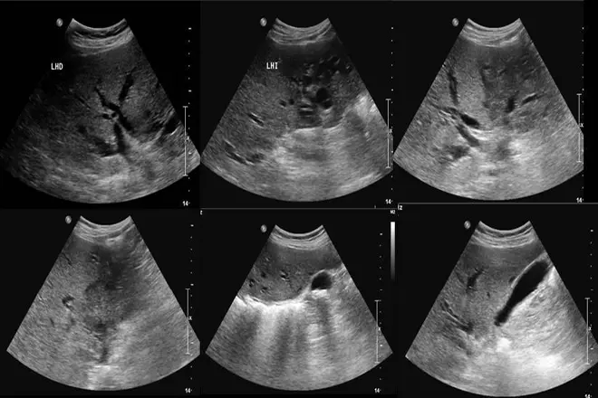 Ecografía Completa de Abdomen: Una Guía Completa - Cómo prepararse para una ecografía de abdomen total ecografia completa de abdomen - Cómo prepararse para una ecografía de abdomen total