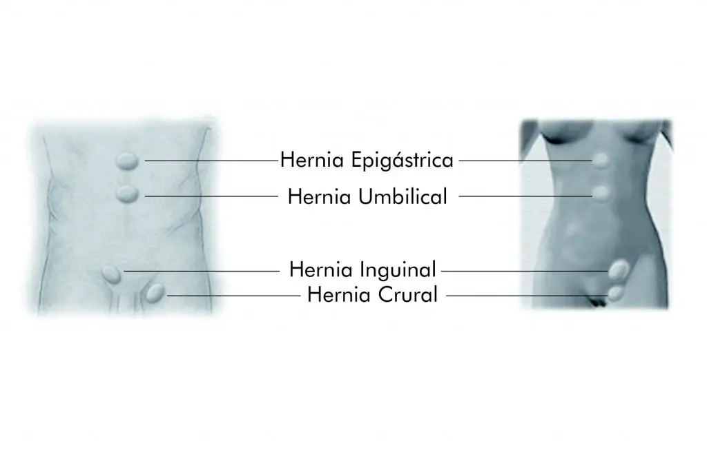 <b>Tipos de Hernia en Mujeres</b>: Una Guía Completa - Cómo puedo saber qué tipo de hernia tengo tipos de hernia en mujeres - Cómo puedo saber qué tipo de hernia tengo