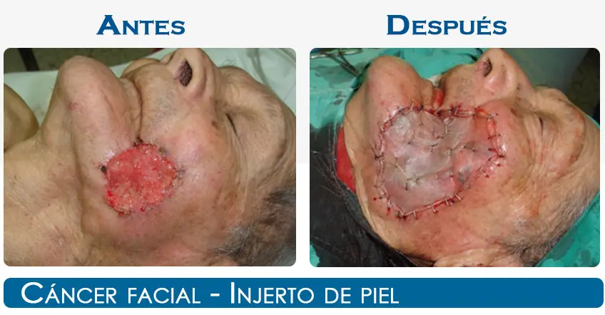 Injerto de piel: Todo lo que necesitas saber - Cómo queda la piel después del injerto injerto de piel - Cómo queda la piel después del injerto