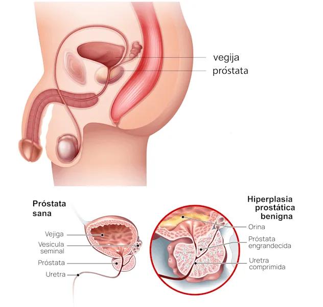 Operación de Próstata: Guía Completa para Pacientes - Cómo queda una persona después de una operación de próstata operacion de prostata - Cómo queda una persona después de una operación de próstata