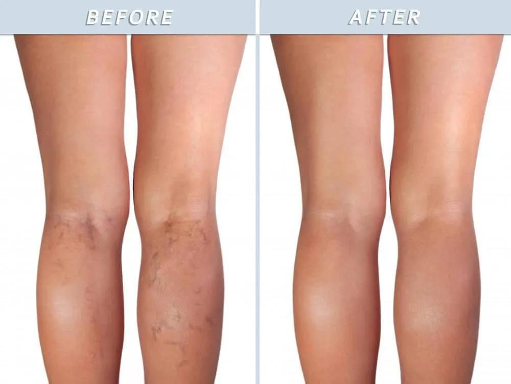 Escleroterapia para Venas Varicosas: Cómo Quedan las Piernas Después del Tratamiento - Cómo quedan las piernas después de la escleroterapia tratamiento esclerosante - Cómo quedan las piernas después de la escleroterapia