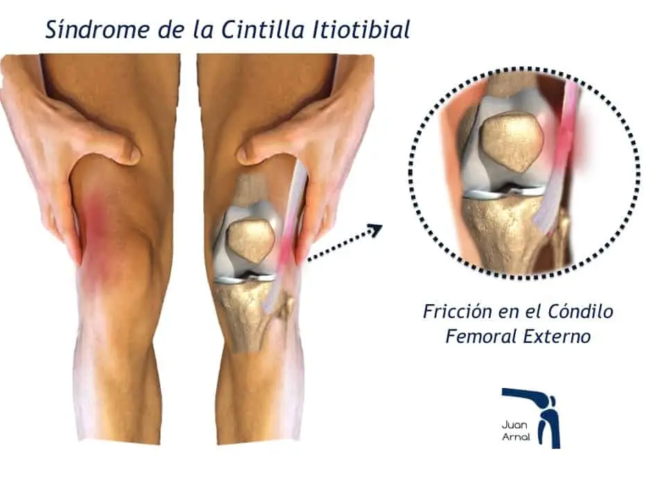 Dolor de Rodilla Derecha: Causas, Diagnóstico y Tratamiento - Cómo quitar el dolor de rodilla rápido y efectivo dolor de rodilla derecha - Cómo quitar el dolor de rodilla rápido y efectivo