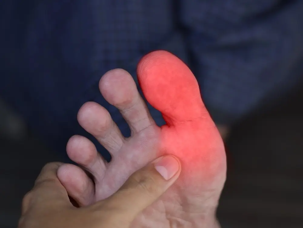 Dolor en el dedo gordo del pie: Causas, síntomas y tratamientos - Cómo quitar el dolor del dedo gordo del pie gota dolor en el dedo gordo del pie - Cómo quitar el dolor del dedo gordo del pie gota