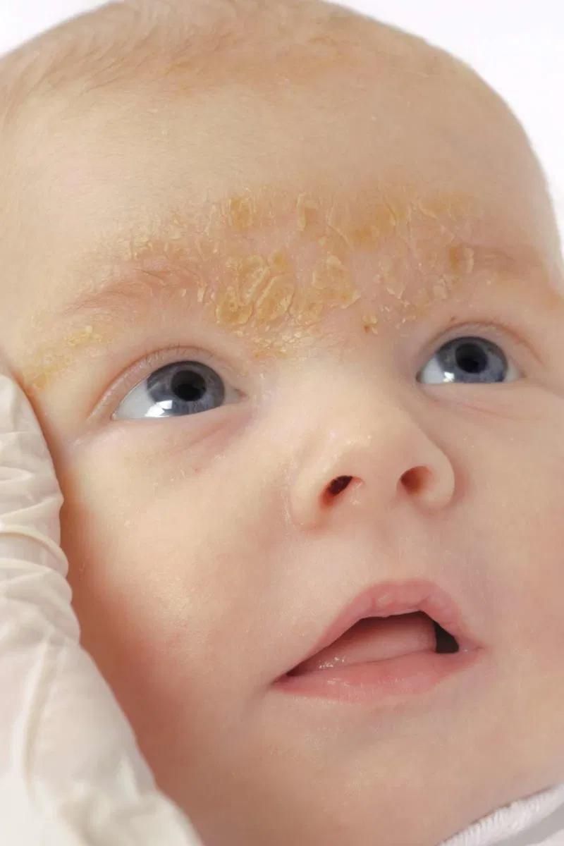 Cómo Quitar la Paspadura de la Cara de un Bebé: Guía Completa para Padres - Cómo quitar la paspa de la cara de un bebé paspadura cara bebe - Cómo quitar la paspa de la cara de un bebé