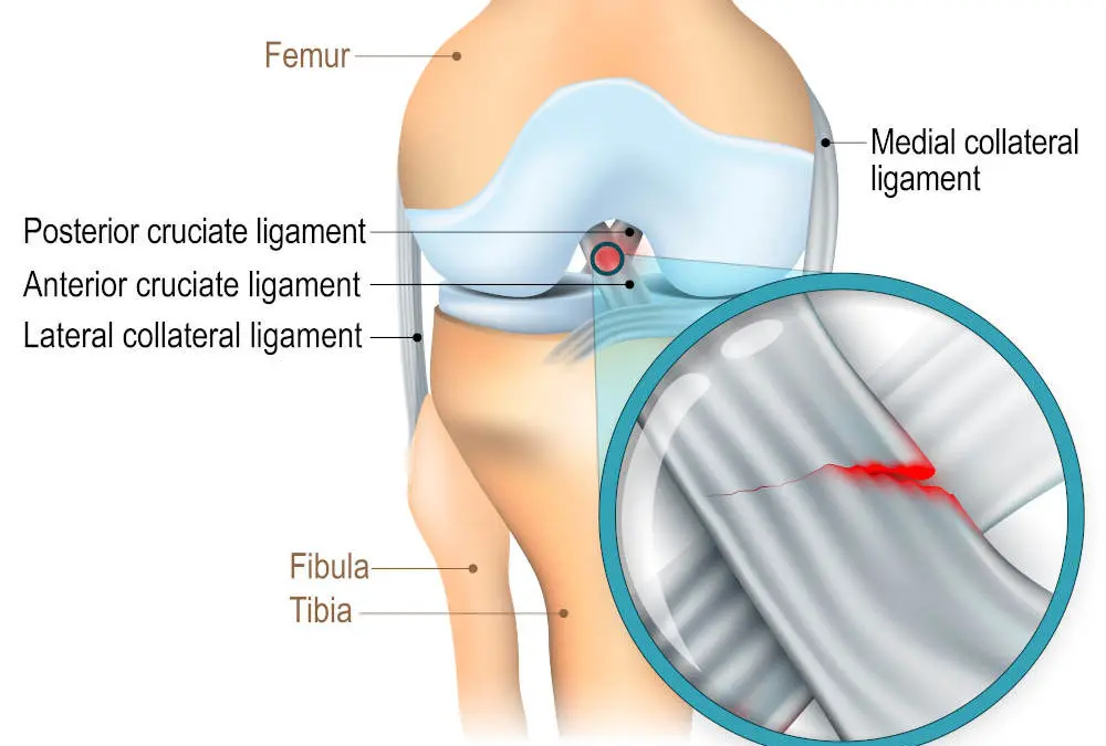 Desgarro del LCA: Diagnóstico, Tratamiento y Recuperación - Cómo recuperar el ligamento cruzado anterior sin cirugía desgarro del lca - Cómo recuperar el ligamento cruzado anterior sin cirugía