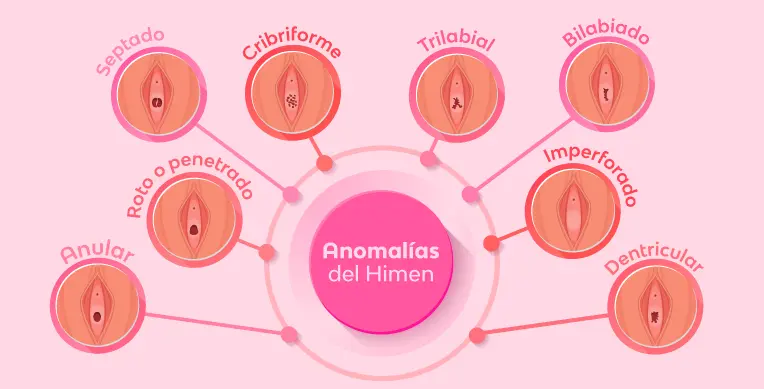 Tipos de Himen: Una Guía Completa para Entender esta Membrana - Cómo saber qué himen tengo tipos de himen - Cómo saber qué himen tengo