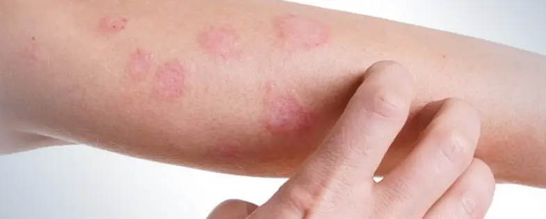 Tipos de alergia: Una guía completa para entender las reacciones alérgicas - Cómo saber qué tipo de alergia tienes tipos de alergia - Cómo saber qué tipo de alergia tienes