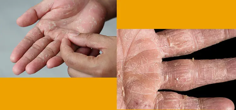 Alergia al Látex: Causas, Síntomas, Diagnóstico y Prevención - Cómo saber si eres alérgico al látex alergia al latex - Cómo saber si eres alérgico al látex