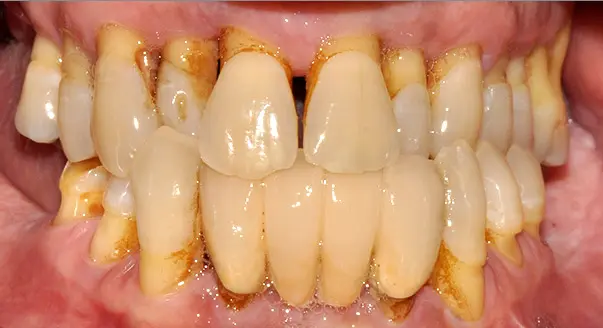 Sangrado de encías: ¿Qué enfermedades lo causan y cómo prevenirlo? - Cómo saber si es gingivitis o periodontitis enfermedades que causan sangrado de encias - Cómo saber si es gingivitis o periodontitis